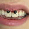 نمونه کار پیرسینگ لبخند