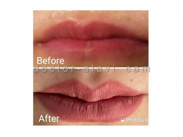 تزریق ژل لب طبیعی رسالت